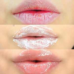  how to get rid of chapped lips