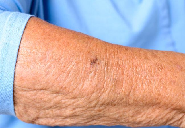 What's causing your crepey skin?