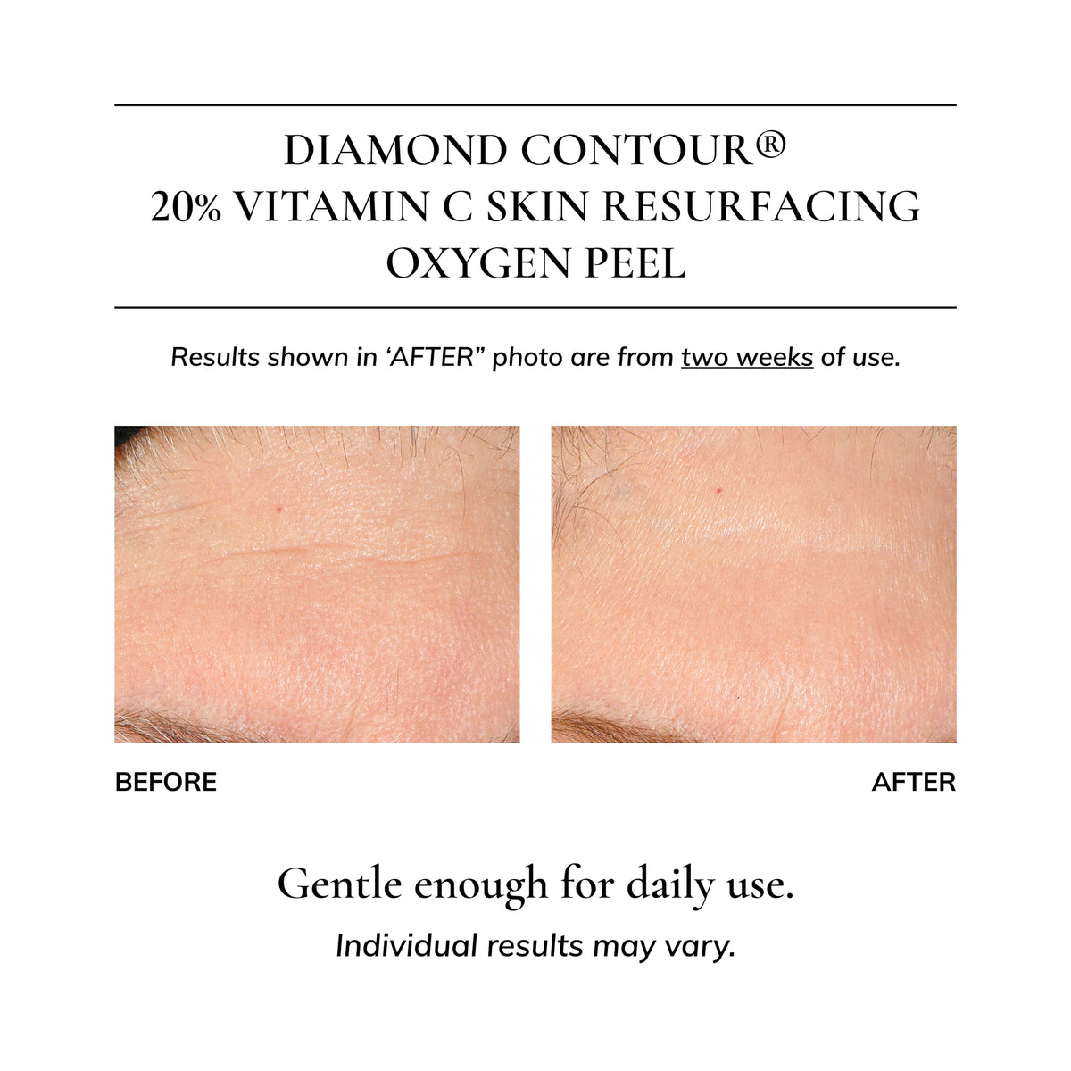 Diamond Contour 20% Vitamin C Skin Resurfacing Oxygen Peel