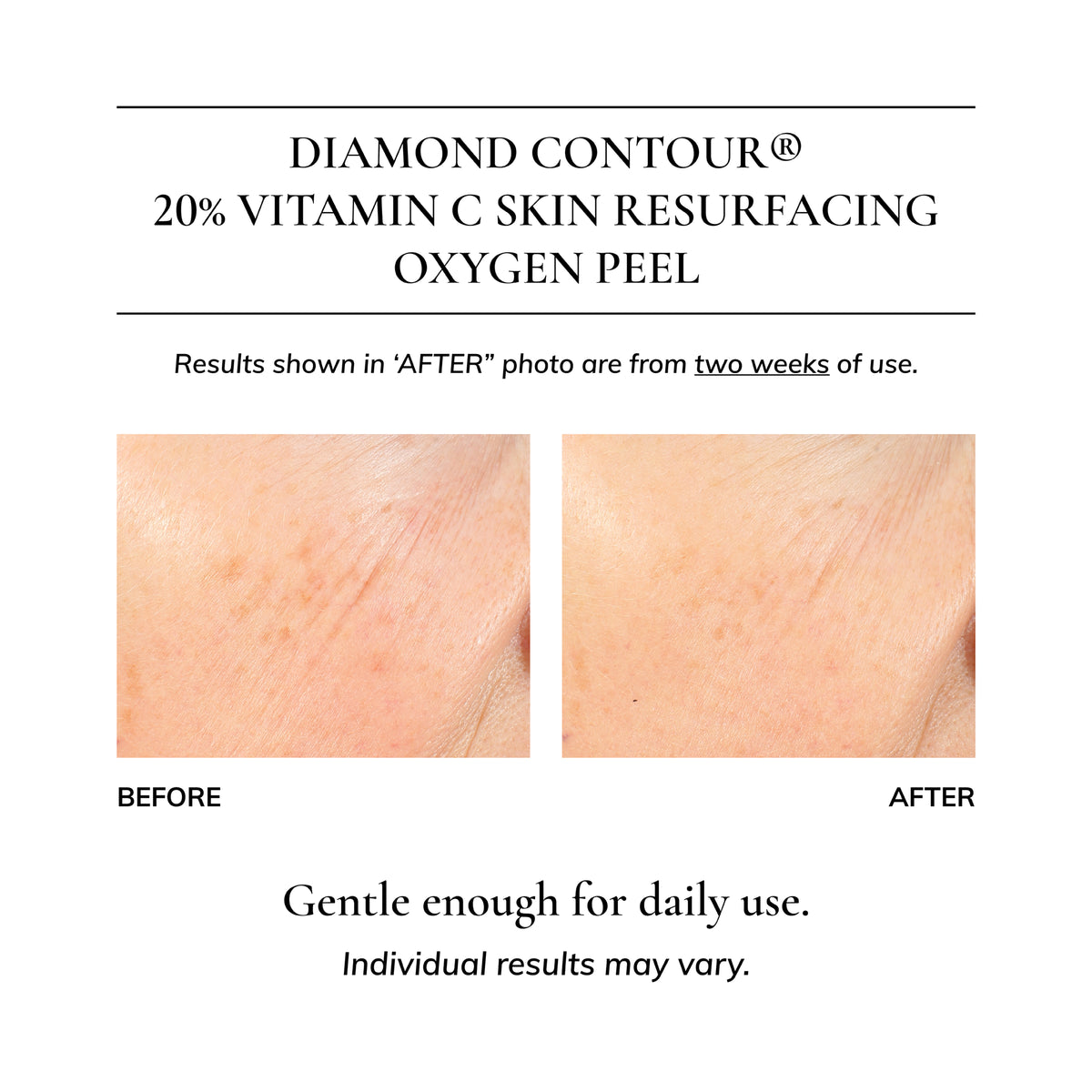 Diamond Contour 20% Vitamin C Skin Resurfacing Oxygen Peel