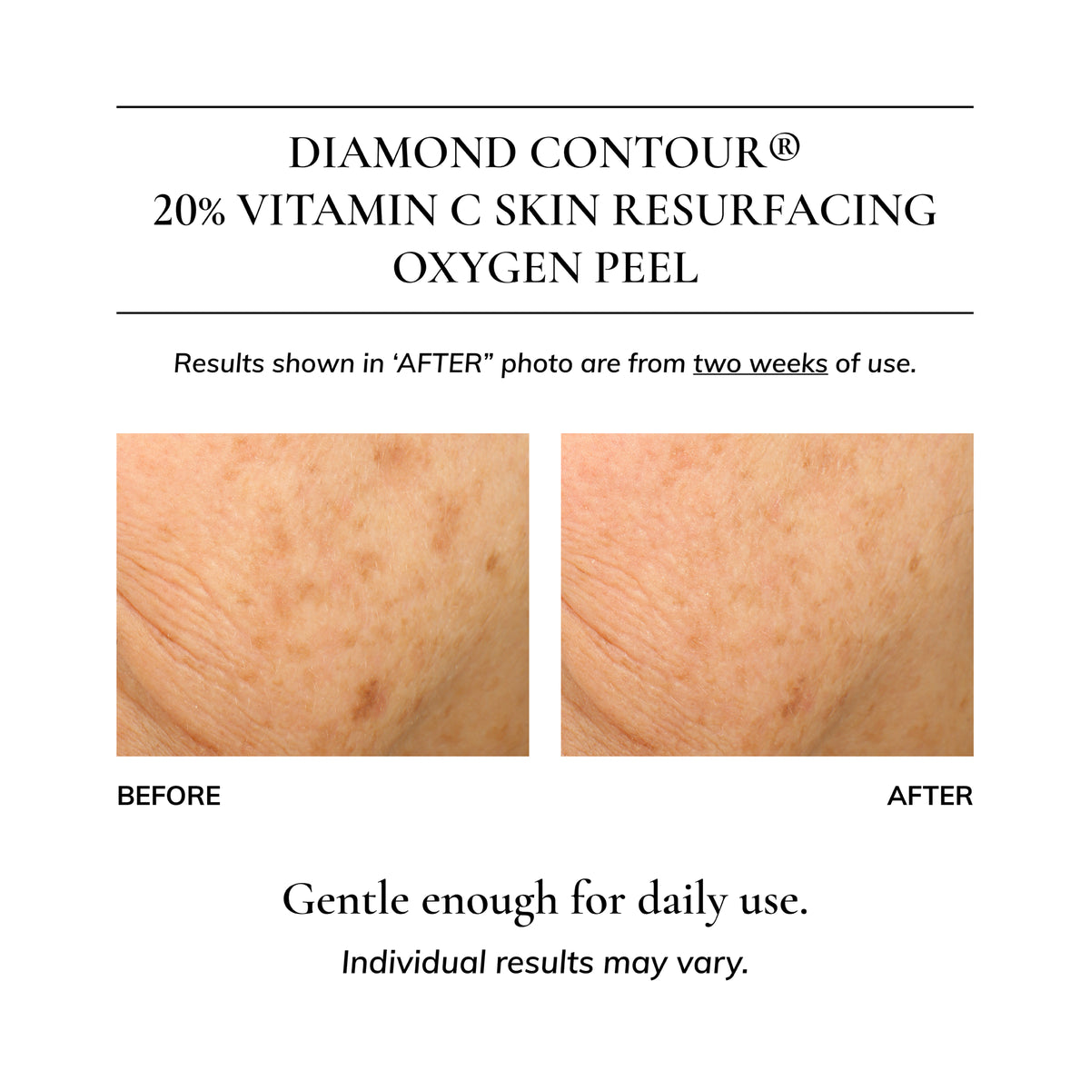 Diamond Contour 20% Vitamin C Skin Resurfacing Oxygen Peel
