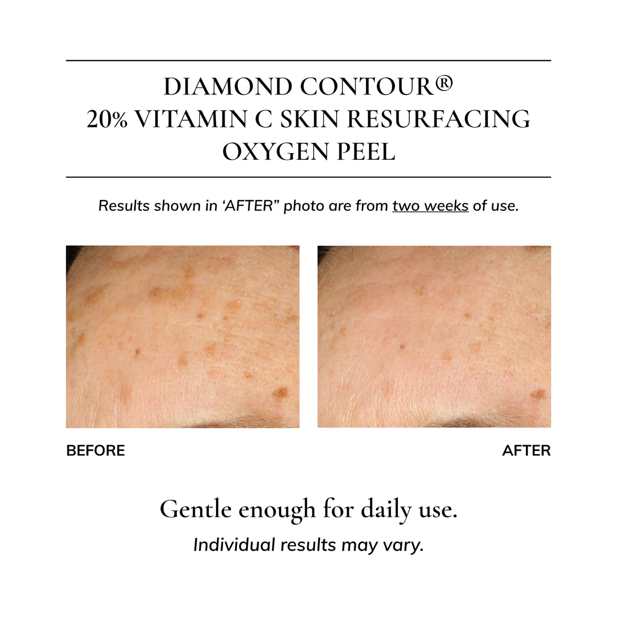 Diamond Contour 20% Vitamin C Skin Resurfacing Oxygen Peel